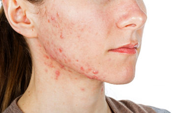Acne nas mulheres adultas, por que isso acontece?