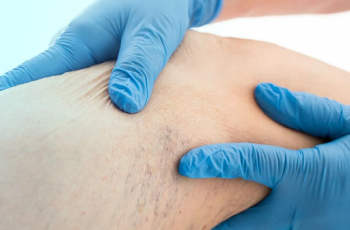 Quando consultar um angiologista?