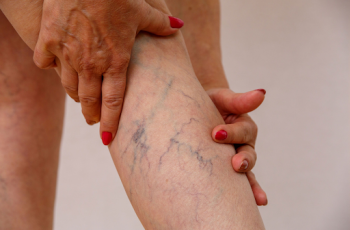 O que é trombose venosa profunda e quando procurar um angiologista?