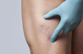 Quais são as principais condições tratadas pelo médico angiologista?