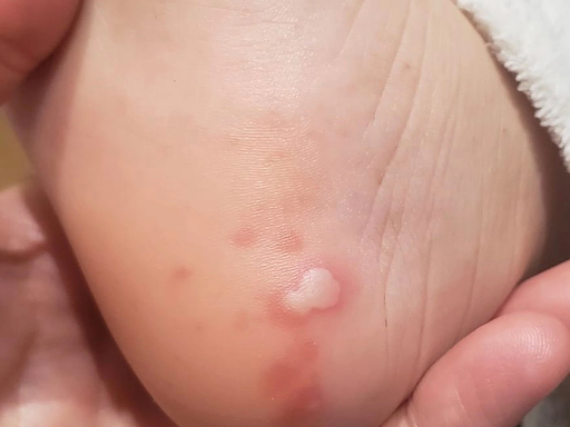 sequelas dermatológicas