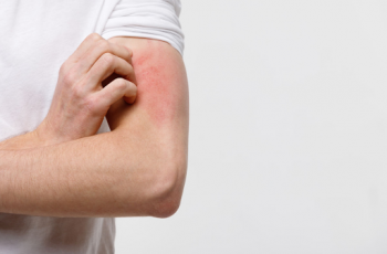 Micose ou alergia na pele: veja como diferenciar