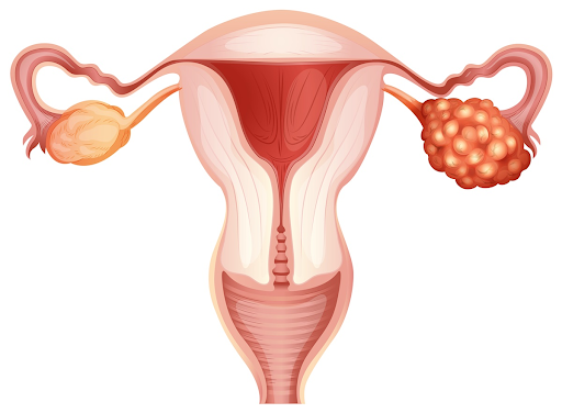 Cistos no ovário: uma grande dúvida das mulheres