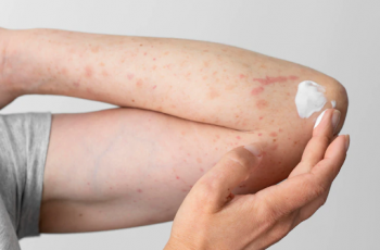 Alergias na pele: Conheça os tipos de alergia e saiba como é o tratamento